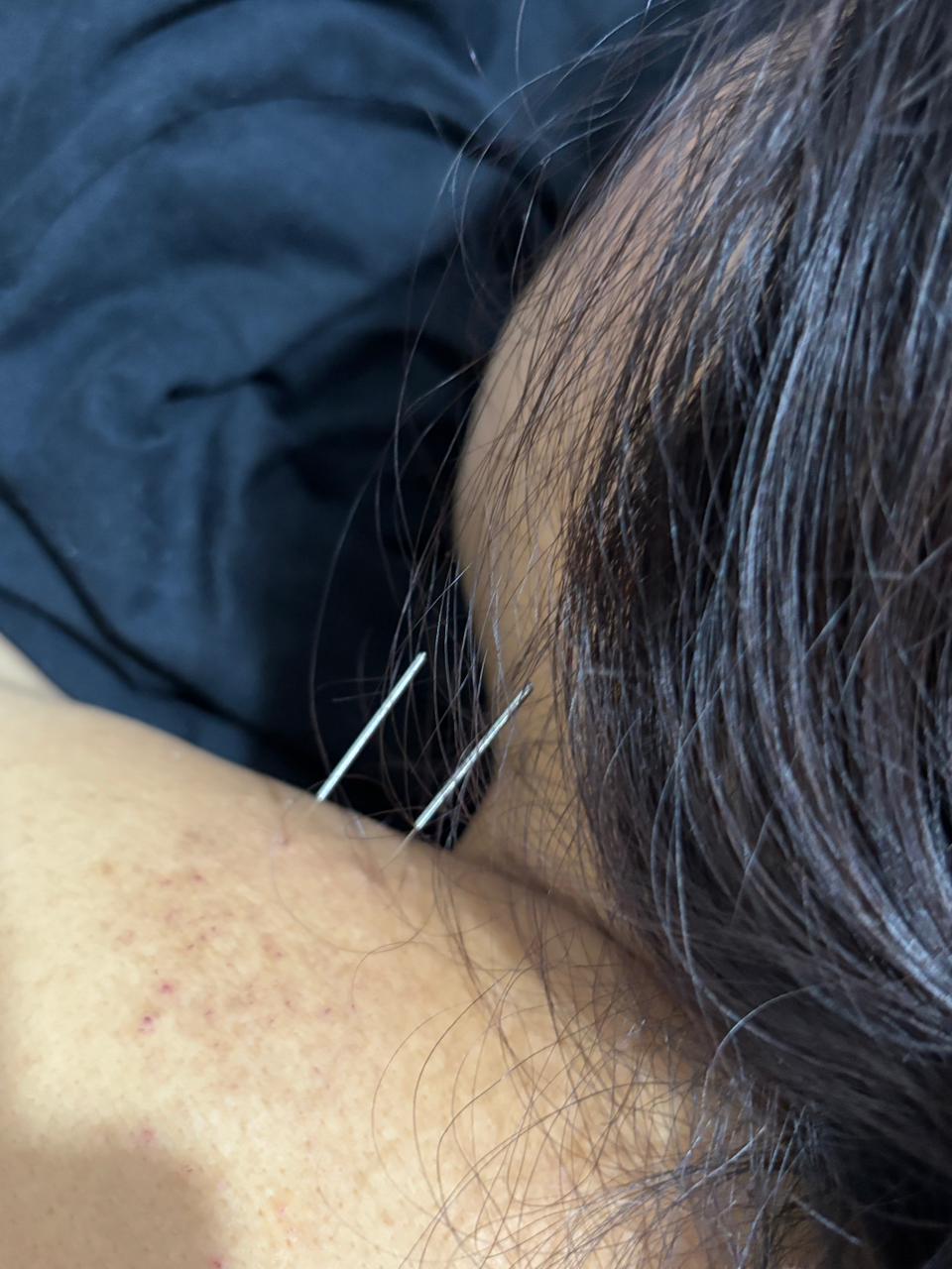 Dry Needling